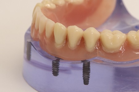 Vollständige Mund Zahnimplantate