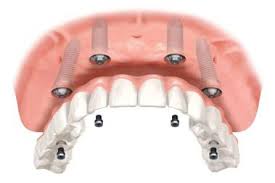 Zahnersatz auf Zahnimplantate
