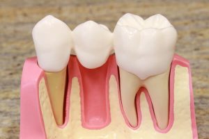 Vorteile von Zahnbrücken