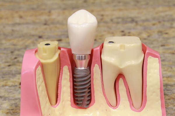 Vorteile von Zahnimplantaten