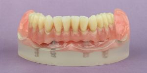 All-on-4 Zahnersatz auf 4 Zahnimplantate
