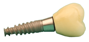 Zahnimplantat mit Zahnkrone